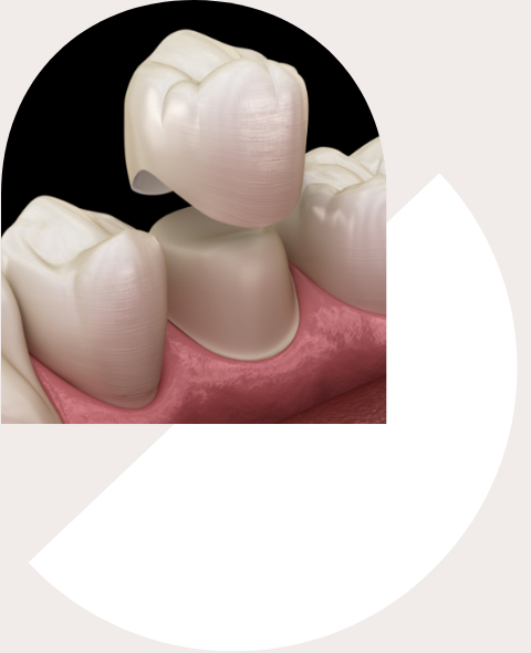 Dental Crowns and Bridges in La Jolla, San Diego